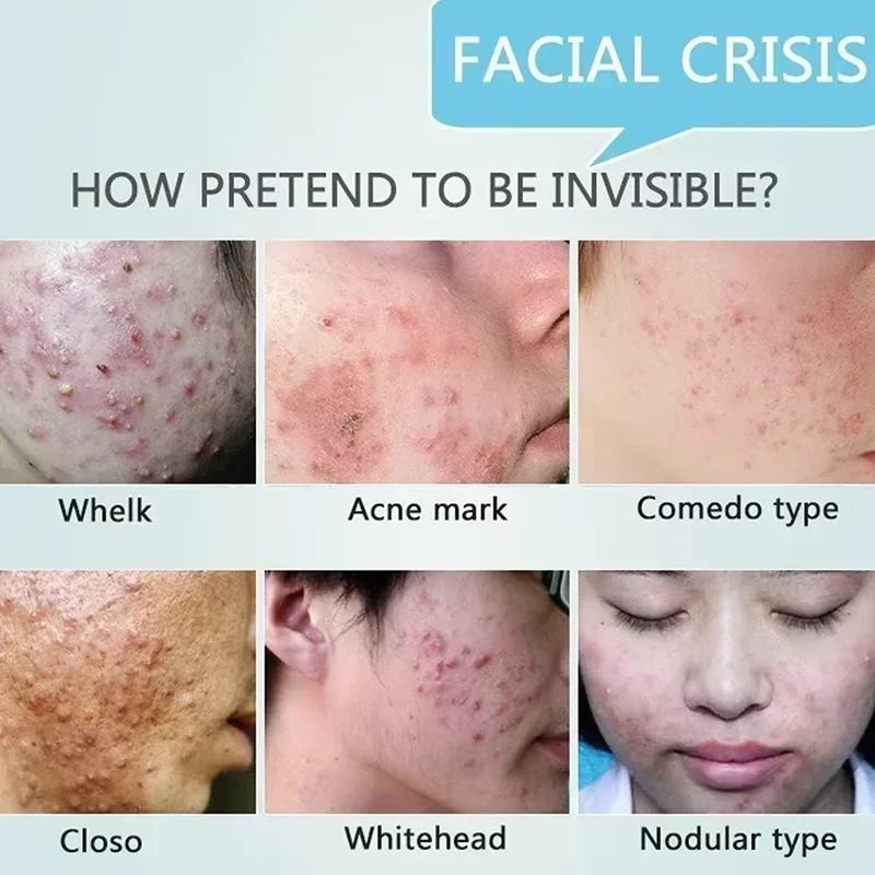 Acne Scar & Pore Repair Cream