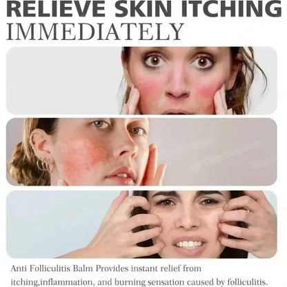 Acne Care Cream – Men & Women Skin Treatment