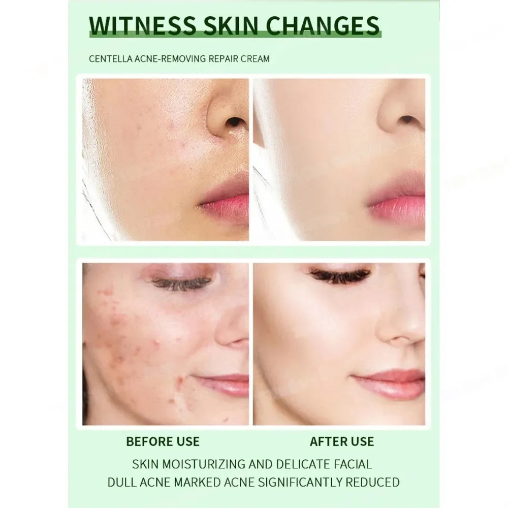 Acne Care Cream – Men & Women Skin Treatment