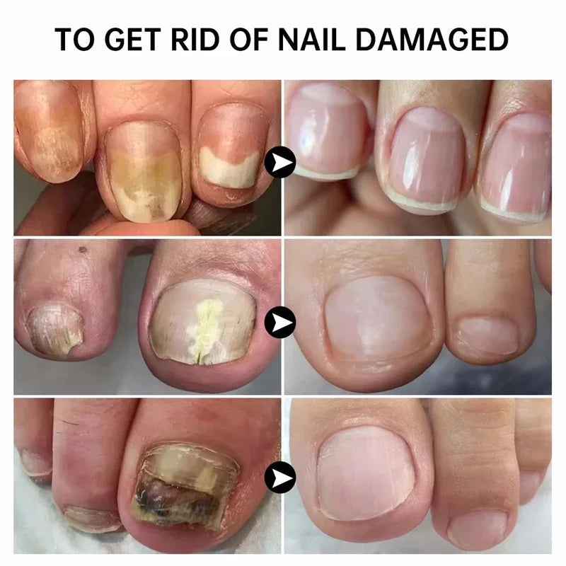 Anti-Fungus Nail Serum