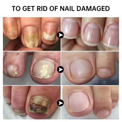 Anti-Fungus Nail Serum